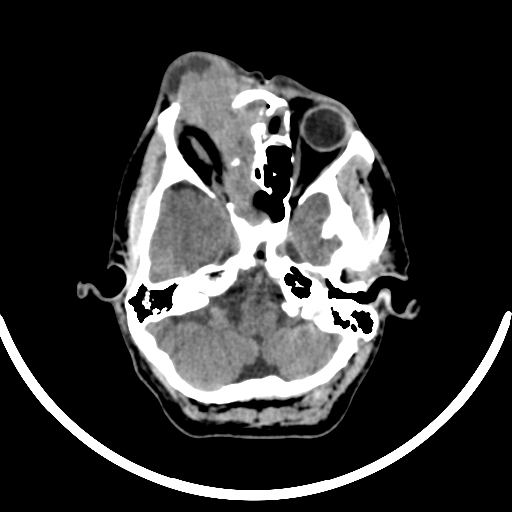 Chronic invasive fungal sinusitis with intraorbital and intracranial extension (Radiopaedia 56387-63046 Axial non-contrast 124).jpg