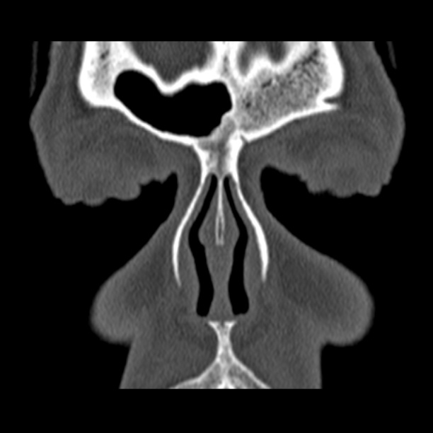 Chronic maxillary sinusitis (Radiopaedia 27879-28116 Coronal bone window 8).jpg