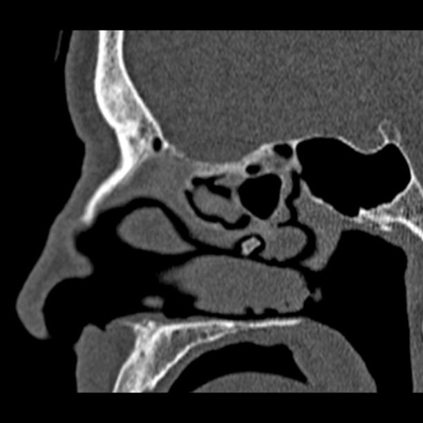 Chronic maxillary sinusitis (Radiopaedia 27879-28116 Sagittal bone window 30).jpg