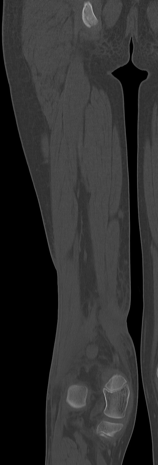 Chronic ostemyelitis of the femur with long sinus tract (Radiopaedia 74947-85982 Coronal bone window 58).jpg