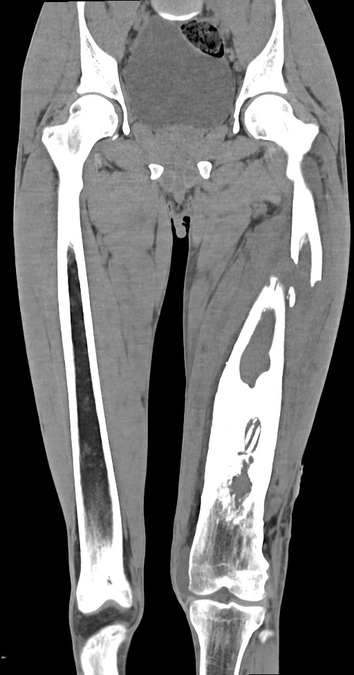 Chronic osteomyelitis (with sequestrum) (Radiopaedia 74813-85822 E 25).jpg