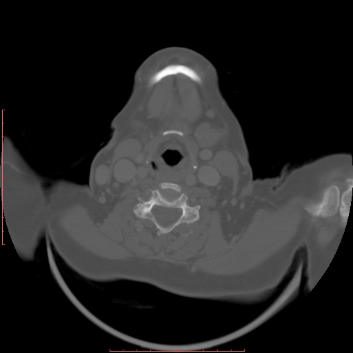 Chronic osteomyelitis - maxilla (Radiopaedia 23783-23927 Axial bone window 1).jpg