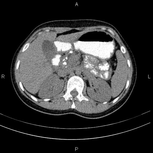 Chronic pancreatitis (Radiopaedia 64576-73450 Axial non-contrast 47).jpg