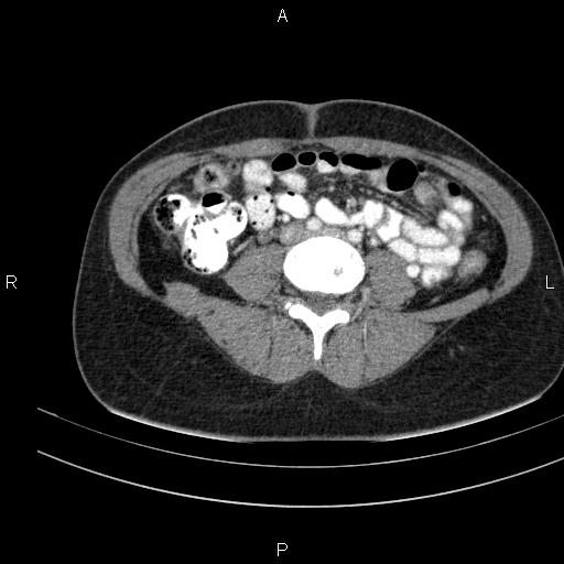 Chronic pancreatitis (Radiopaedia 64576-73450 B 102).jpg