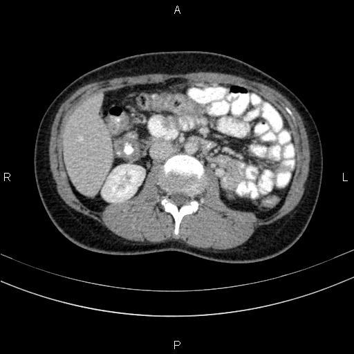 Chronic pancreatitis (Radiopaedia 64576-73450 C 76).jpg