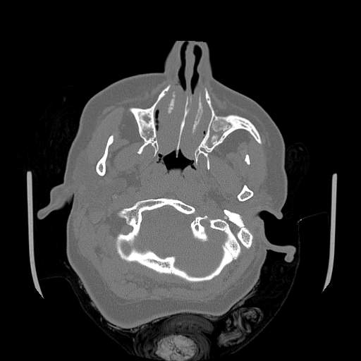 Chronic sinusitis with intra-sinus calcification (Radiopaedia 63919-72668 Axial bone window 66).jpg