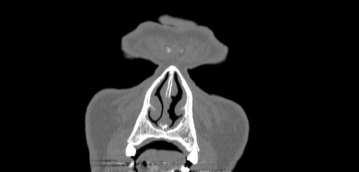 Chronic sphenoidal sinusitis (Radiopaedia 62030-70122 Coronal bone window 2).jpg