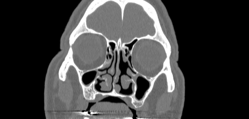 Chronic sphenoidal sinusitis (Radiopaedia 62030-70122 Coronal bone window 43).jpg