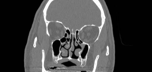 Chronic sphenoidal sinusitis (Radiopaedia 62030-70122 Coronal bone window 68).jpg