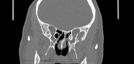 Chronic sphenoidal sinusitis (Radiopaedia 62030-70122 Coronal bone window 96).jpg