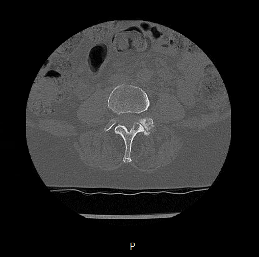Chronic spinal hematoma with cauda equina syndrome (Radiopaedia 75745-88197 Axial bone window 35).png