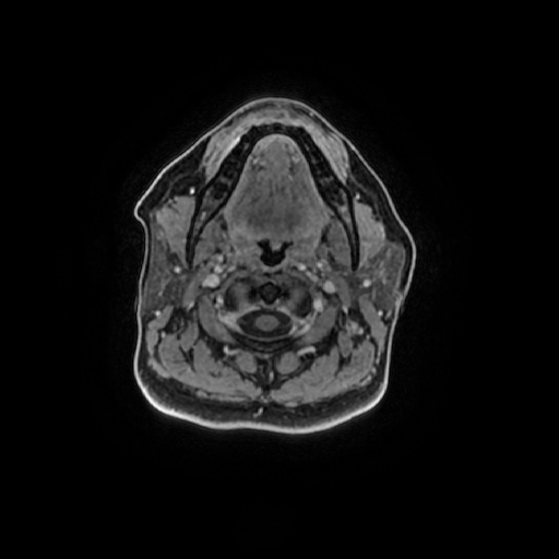 Chronic submandibular sialadenitis (Radiopaedia 61852-69885 Axial T1 C+ fat sat 75).jpg