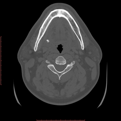 Chronic submandibular sialolithiasis (Radiopaedia 69817-79814 Axial bone window 69).jpg