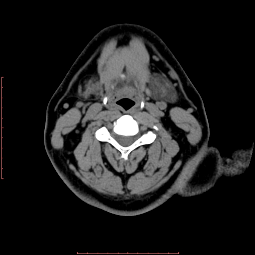 File:Chronic submandibular sialolithiasis (Radiopaedia 69817-79814 Axial non-contrast 133).jpg