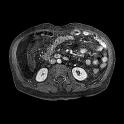 Cirrhosis and hepatocellular carcinoma in the setting of hemochromatosis (Radiopaedia 75394-86594 Axial T1 C+ fat sat 184).jpg