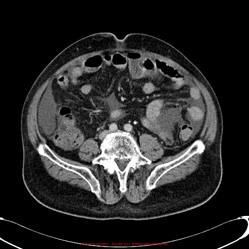 File:Cirrhosis and hepatocellular carcinoma in the setting of hemochromatosis (Radiopaedia 75394-86595 B 58).jpg