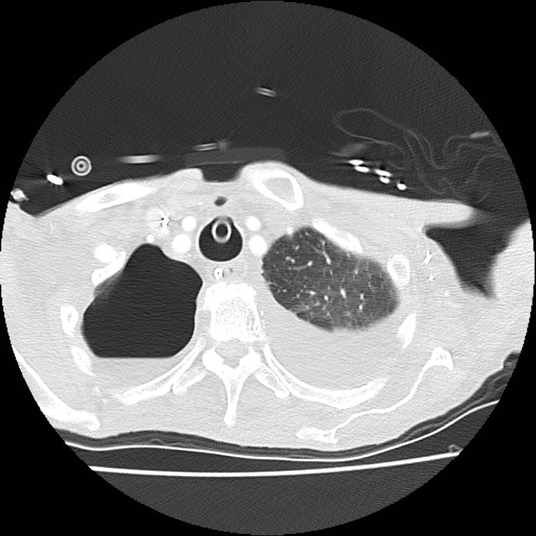 Clagett thoracotomy with bronchopleural fistula (Radiopaedia 29192-29587 Axial lung window 6).jpg