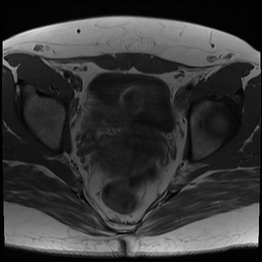File:Class II Mullerian duct anomaly- unicornuate uterus with rudimentary horn and non-communicating cavity (Radiopaedia 39441-41755 Axial T1 18).jpg