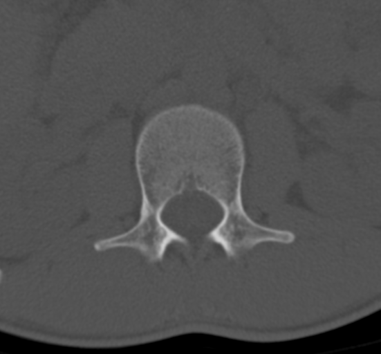 Clear cell meningoma - lumbar spine (Radiopaedia 60116-67691 Axial bone window 15).png