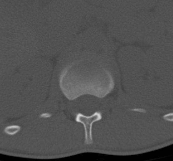 Clear cell meningoma - lumbar spine (Radiopaedia 60116-67691 Axial bone window 7).png