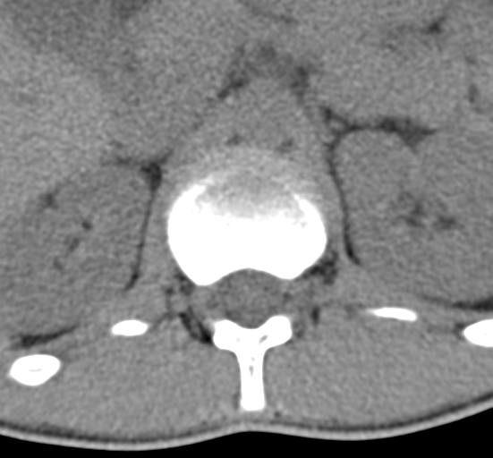 Clear cell meningoma - lumbar spine (Radiopaedia 60116-67691 Axial non-contrast 7).png