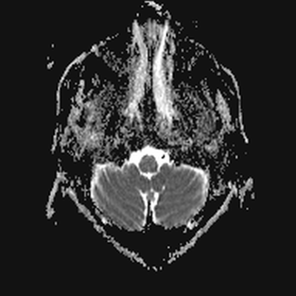File:Clival meningioma (Radiopaedia 53278-59248 Axial ADC 2).jpg