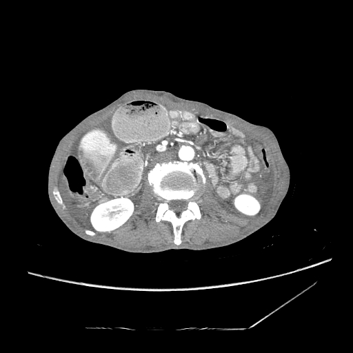 Closed-loop obstruction due to peritoneal seeding mimicking internal hernia after total gastrectomy (Radiopaedia 81897-95864 A 85).jpg