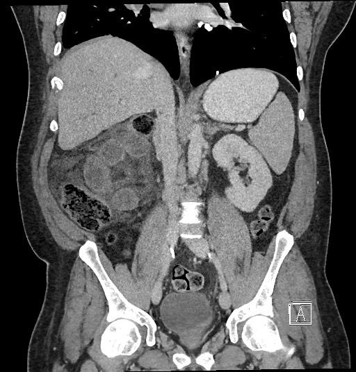 Closed loop obstruction - internal hernia into nephrectomy bed (Radiopaedia 59867-67320 B 79).jpg