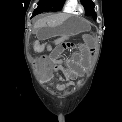 File:Closed loop obstruction due to adhesive band, resulting in small bowel ischemia and resection (Radiopaedia 83835-99023 C 33).jpg
