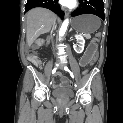 Closed loop obstruction due to adhesive band, resulting in small bowel ischemia and resection (Radiopaedia 83835-99023 C 69).jpg