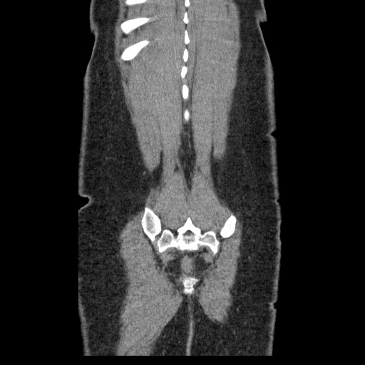 Closed loop small bowel obstruction (Radiopaedia 65403-74451 B 95).jpg