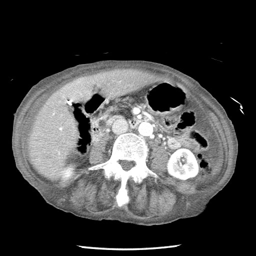 Closed loop small bowel obstruction - adhesions and infarct (Radiopaedia 85125-100678 B 46).jpg