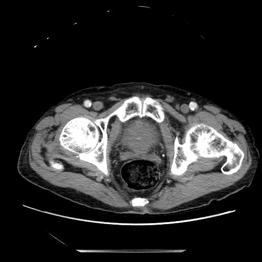 Closed loop small bowel obstruction - adhesive disease and hemorrhagic ischemia (Radiopaedia 86831-102990 A 171).jpg