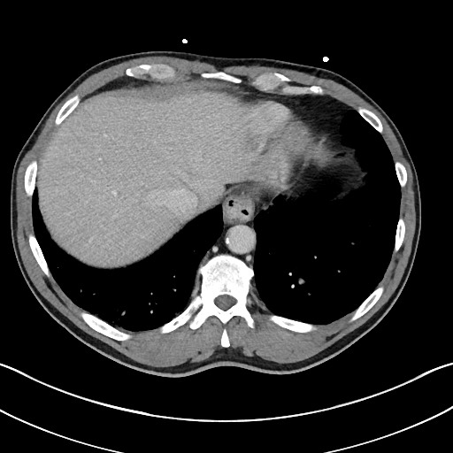 Closed loop small bowel obstruction - internal hernia (Radiopaedia 57806-64778 B 16).jpg