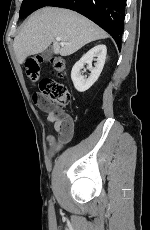 Closed loop small bowel obstruction - internal hernia (Radiopaedia 57806-64778 C 83).jpg