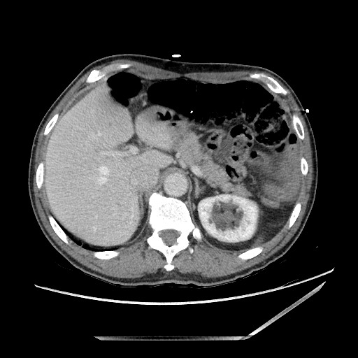 Closed loop small bowel obstruction - omental adhesion causing "internal hernia" (Radiopaedia 85129-100682 A 36).jpg