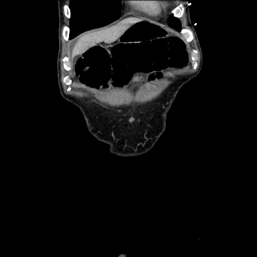 Closed loop small bowel obstruction - omental adhesion causing "internal hernia" (Radiopaedia 85129-100682 B 26).jpg