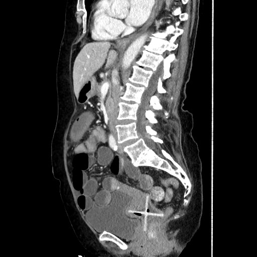 Closed loop small bowel obstruction due to adhesive band, with intramural hemorrhage and ischemia (Radiopaedia 83831-99017 D 104).jpg