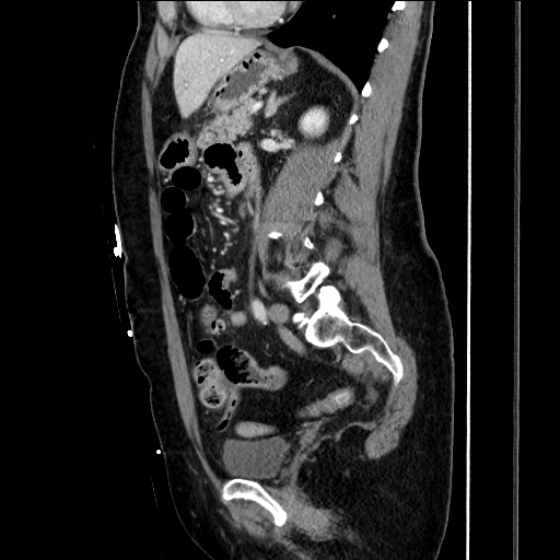 Closed loop small bowel obstruction due to adhesive bands - early and late images (Radiopaedia 83830-99014 C 109).jpg