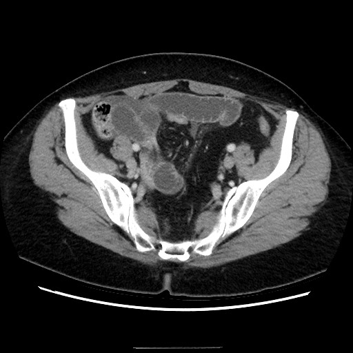 Closed loop small bowel obstruction due to adhesive bands - early and late images (Radiopaedia 83830-99015 A 131).jpg