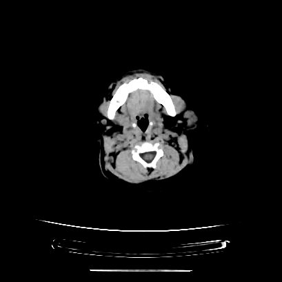 Cloverleaf skull (Radiopaedia 91901-109710 Axial non-contrast 26).jpg