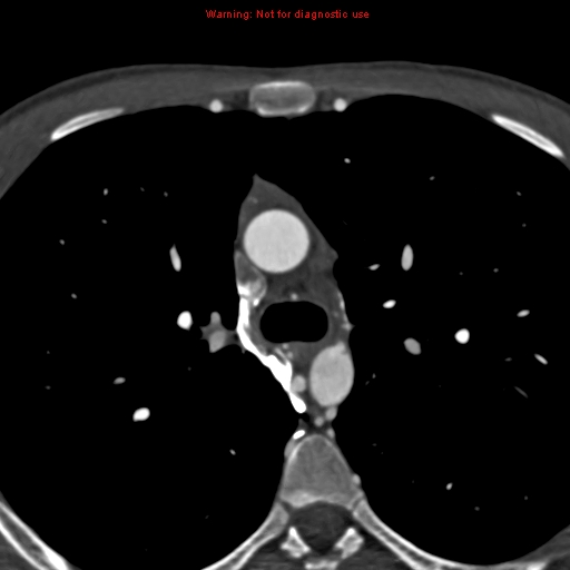 File:Coarctation of the aorta (Radiopaedia 12461-12697 A 127).jpg