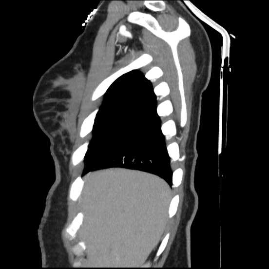 Coarctation of the aorta (Radiopaedia 67609-77010 C 57).jpg