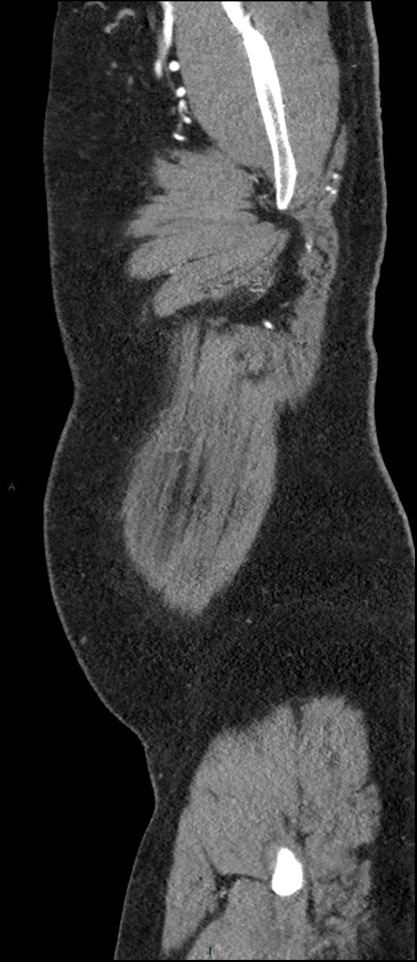Coarctation of the aorta (Radiopaedia 74632-88521 C 1).jpg