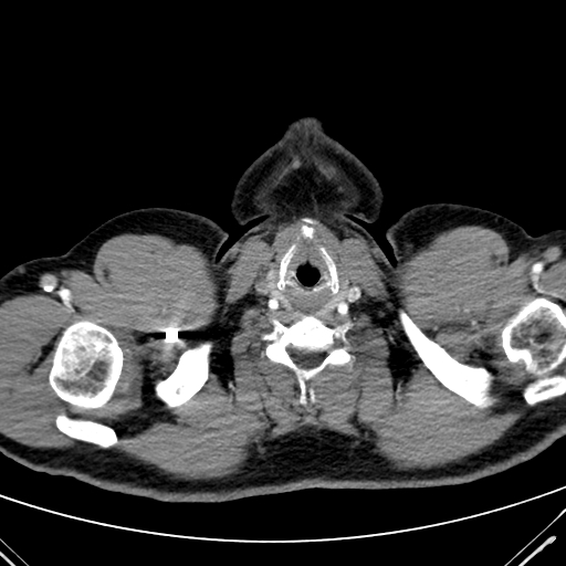 Codominant double aortic arch (Radiopaedia 56012-62637 A 1).jpg