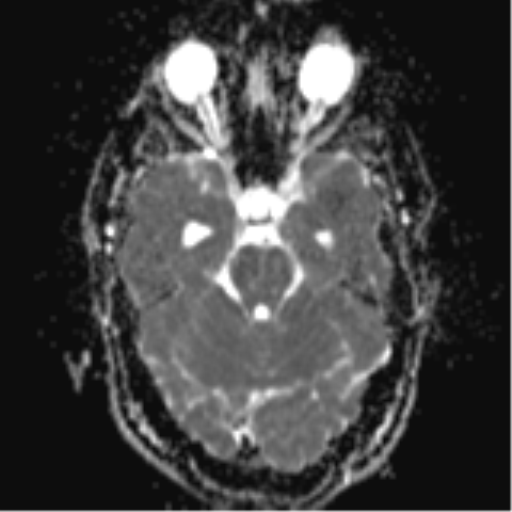 File:Colloid cyst (Radiopaedia 44510-48181 Axial ADC 9).png