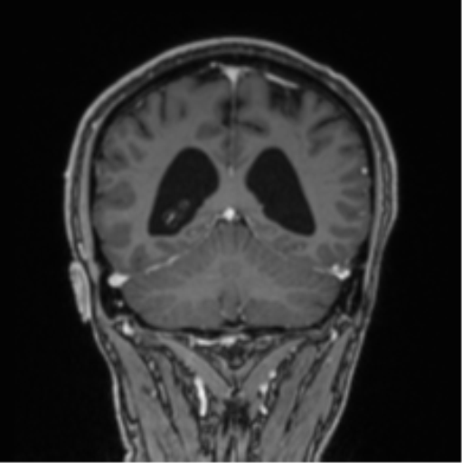 File:Colloid cyst of the third ventricle (Radiopaedia 86571-102662 Coronal T1 C+ 30).png