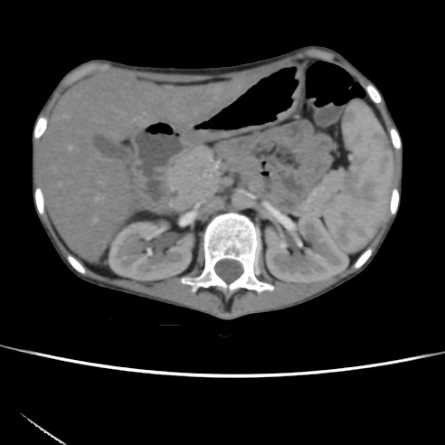 File:Colocolic fistula - Crohn disease (Radiopaedia 57063-63955 A 23).jpg