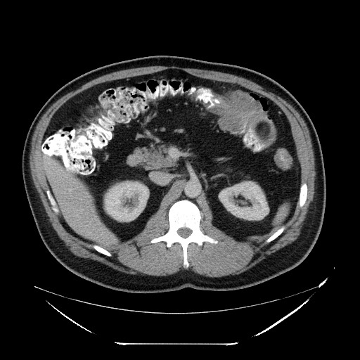 Colocolic intussusception due to lipoma (Radiopaedia 73712-84508 A 41).jpg