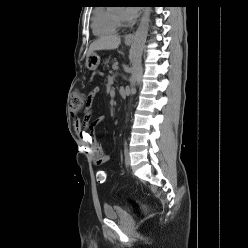 Colocutaneous fistula in Crohn's disease (Radiopaedia 29586-30093 F 21).jpg